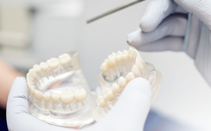 Коронки на зубы: преимущества и этапы процедуры