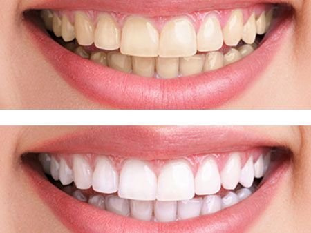 Отбеливание зубов - Возвращение белизны и уверенности в улыбке